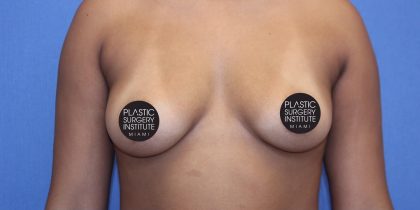 Breast Augmentation Before & After Patient #1378