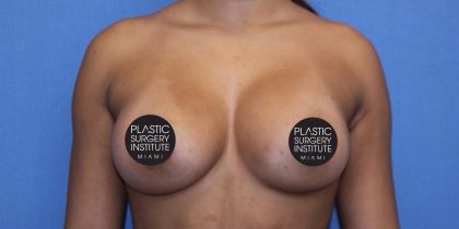 Breast Augmentation Before & After Patient #1378