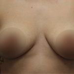 Breast Lift Before & After Patient #1380