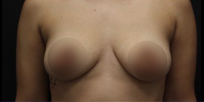 Breast Lift Before & After Patient #1380