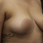 Breast Lift Before & After Patient #1380