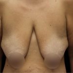 Breast Reduction Before & After Patient #1381