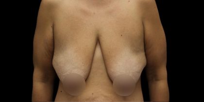 Breast Reduction Before & After Patient #1381