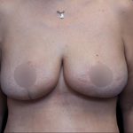 Breast Reduction Before & After Patient #1381