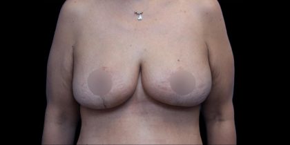 Breast Reduction Before & After Patient #1381