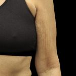 Arm Contouring Before & After Patient #1383