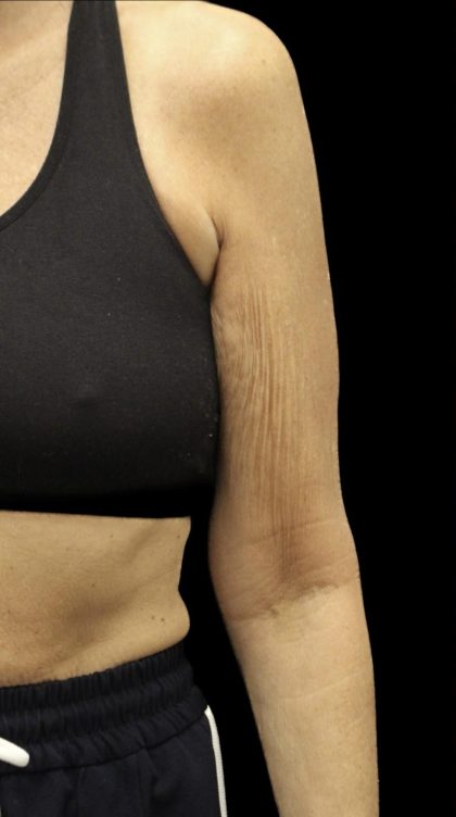 Arm Contouring Before & After Patient #1383