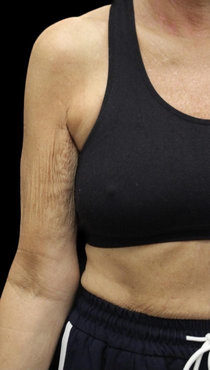 Arm Contouring Before & After Patient #1383