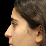 Primary Rhinoplasty Before & After Patient #1387