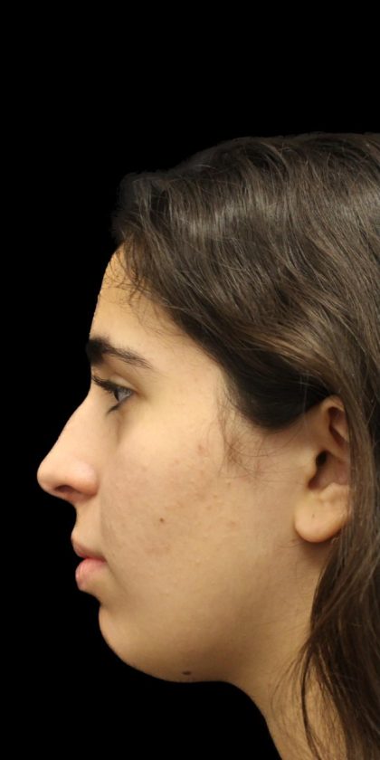 Primary Rhinoplasty Before & After Patient #1387