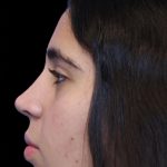 Primary Rhinoplasty Before & After Patient #1387