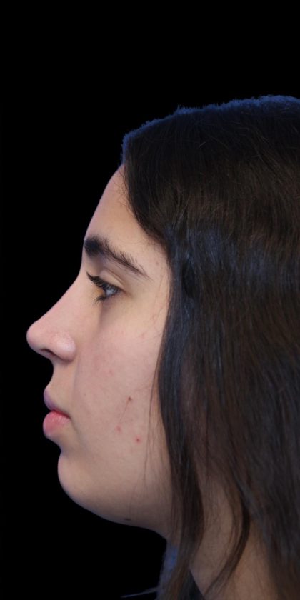 Primary Rhinoplasty Before & After Patient #1387