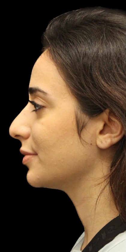 Primary Rhinoplasty Before & After Patient #1389