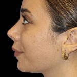 Primary Rhinoplasty Before & After Patient #1389