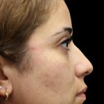 Primary Rhinoplasty Before & After Patient #1390