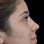 Primary Rhinoplasty Before & After Patient #1390