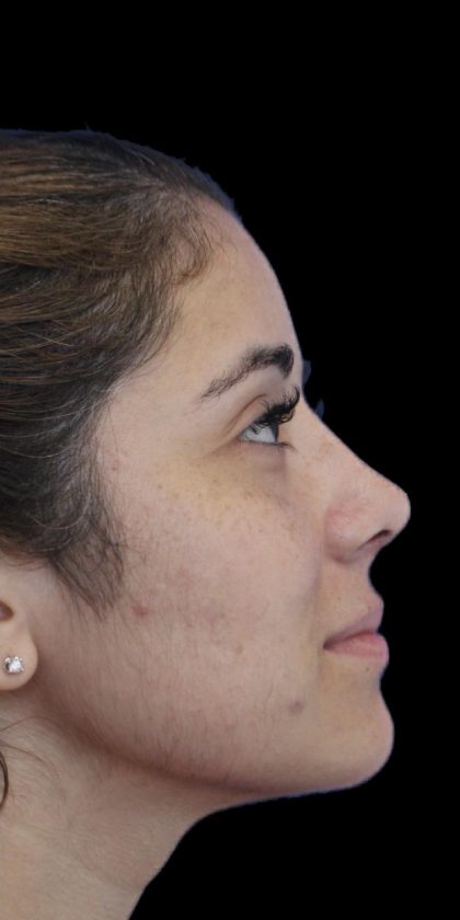 Primary Rhinoplasty Before & After Patient #1390