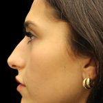 Primary Rhinoplasty Before & After Patient #1392
