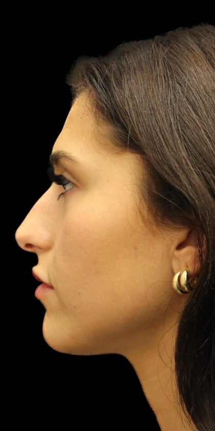 Primary Rhinoplasty Before & After Patient #1392