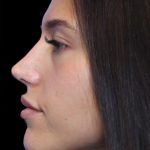 Primary Rhinoplasty Before & After Patient #1392