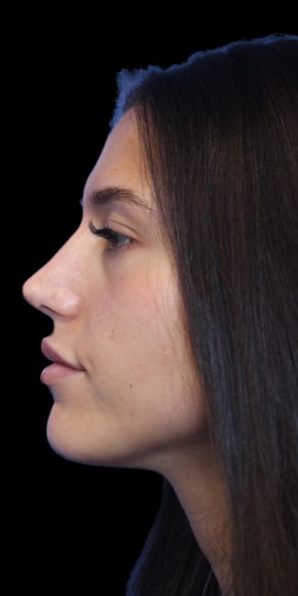 Primary Rhinoplasty Before & After Patient #1392