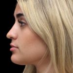 Primary Rhinoplasty Before & After Patient #1393