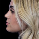 Primary Rhinoplasty Before & After Patient #1393