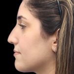 Primary Rhinoplasty Before & After Patient #1395