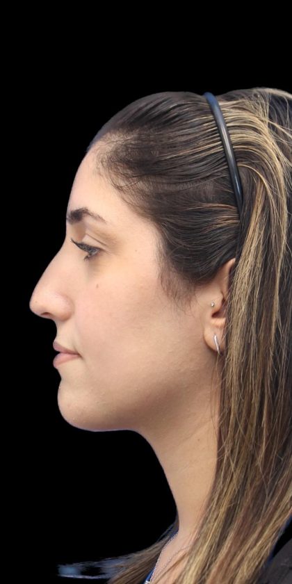 Primary Rhinoplasty Before & After Patient #1395