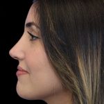 Primary Rhinoplasty Before & After Patient #1395