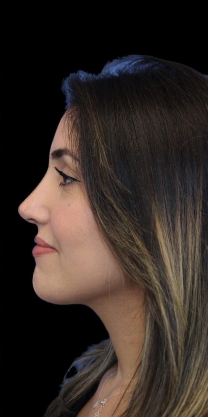 Primary Rhinoplasty Before & After Patient #1395