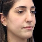 Primary Rhinoplasty Before & After Patient #1395