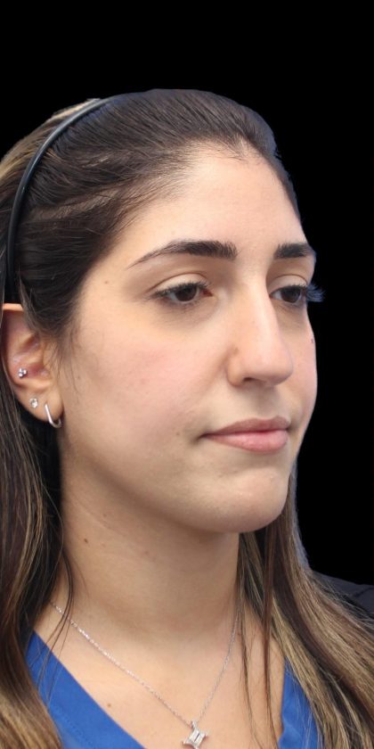 Primary Rhinoplasty Before & After Patient #1395