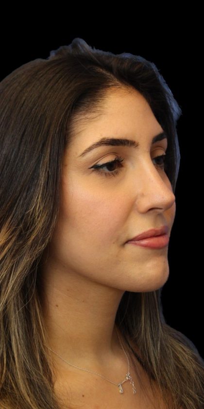 Primary Rhinoplasty Before & After Patient #1395