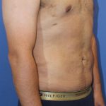 Liposuction/Liposculpture Before & After Patient #1488