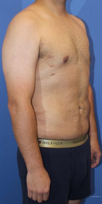 Liposuction/Liposculpture Before & After Patient #1488