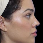 Primary Rhinoplasty Before & After Patient #1516