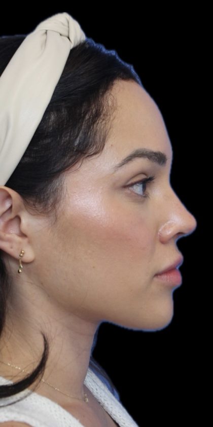 Primary Rhinoplasty Before & After Patient #1516