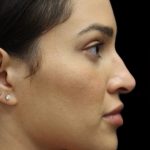 Primary Rhinoplasty Before & After Patient #1516