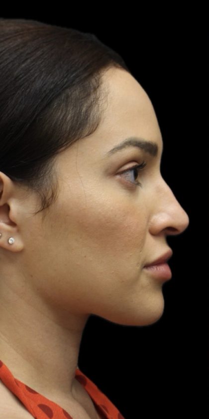 Primary Rhinoplasty Before & After Patient #1516