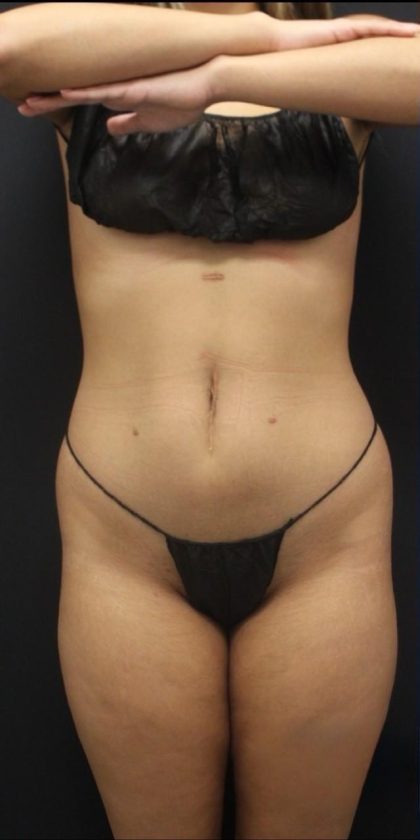 360 Liposuction Before & After Patient #1622