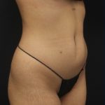 360 Liposuction Before & After Patient #1622