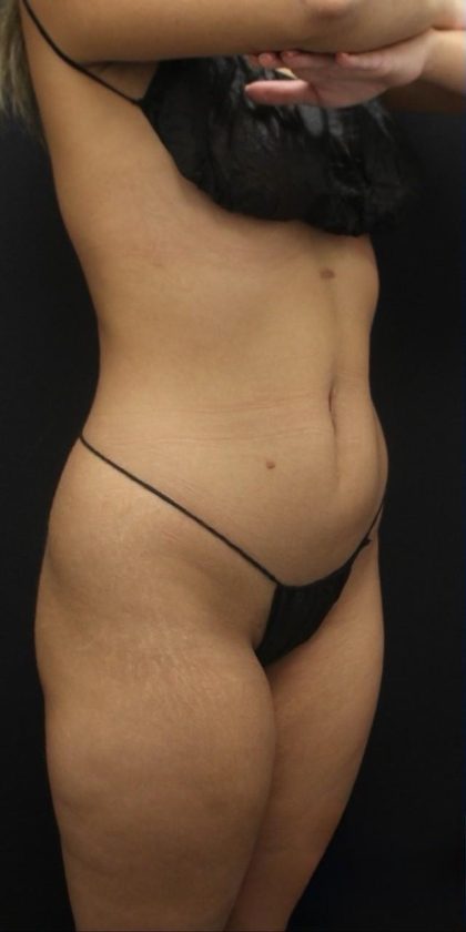 360 Liposuction Before & After Patient #1622