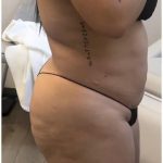 360 Liposuction Before & After Patient #1624