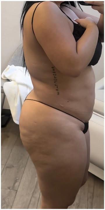 360 Liposuction Before & After Patient #1624