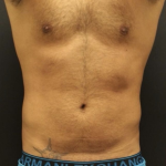 Abdominal Etching Before & After Patient #1627