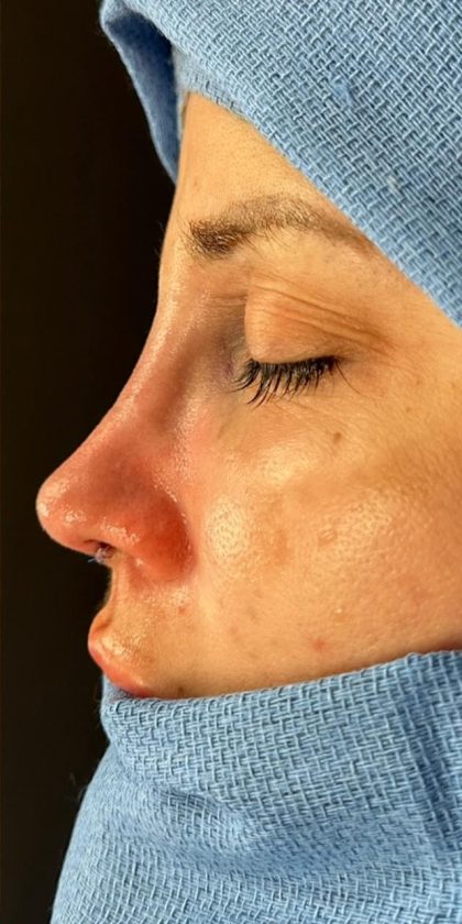 Revision Rhinoplasty Before & After Patient #1613