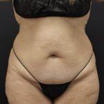 Tummy Tuck Before & After Patient #1614