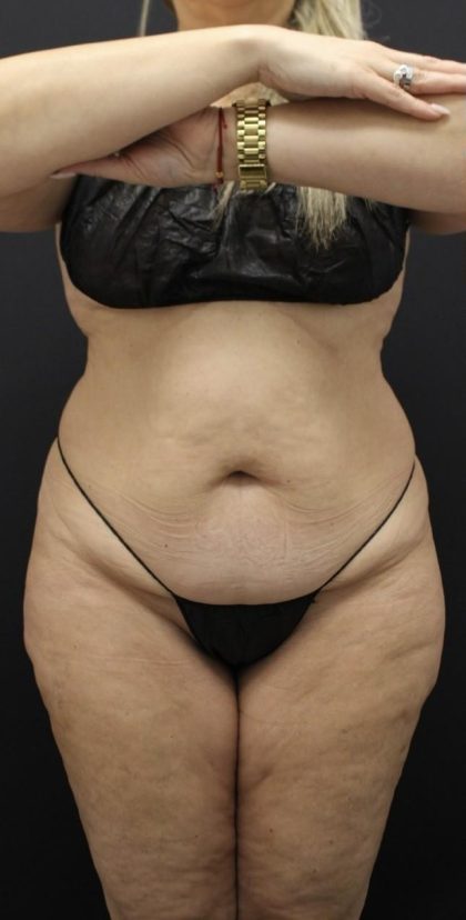 Tummy Tuck Before & After Patient #1614