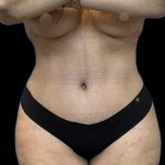 Tummy Tuck Before & After Patient #1614